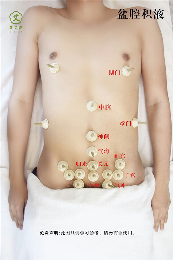 盆腔结核艾灸哪里？怎么贴？艾艾贴使用方法