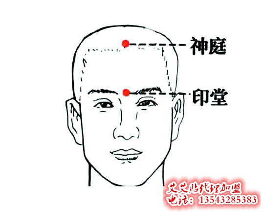 艾艾贴调理神庭穴位指示图