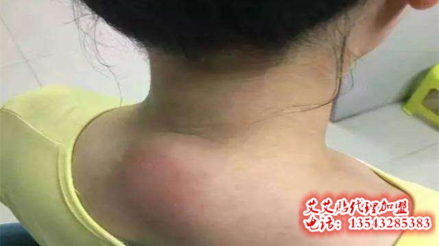 用艾艾贴如何调理富贵包?