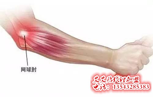 网球肘如何用艾艾贴调理?