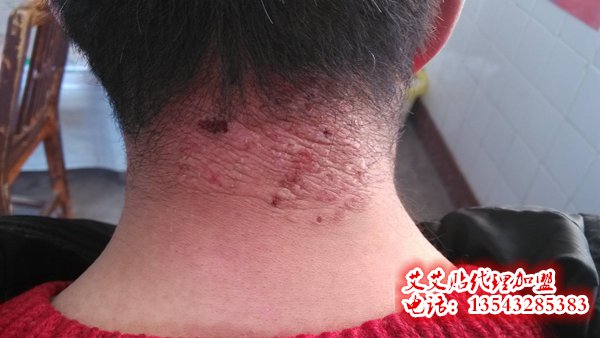 神经性皮炎用艾艾贴如何调理?