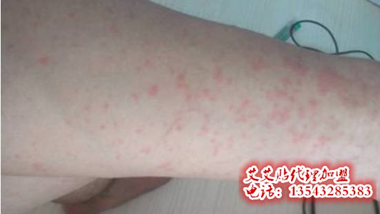 泽红总代邀你测一测你是几级寒湿体质 泽红总代邀你测一测你是几级寒湿体质