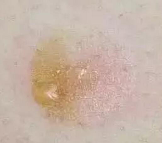 艾艾贴排病反应 艾艾贴排病反应