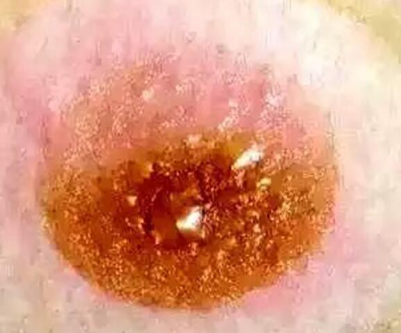 艾艾贴排病反应 艾艾贴排病反应