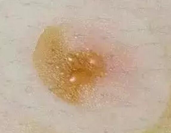 艾艾贴排病反应 艾艾贴排病反应
