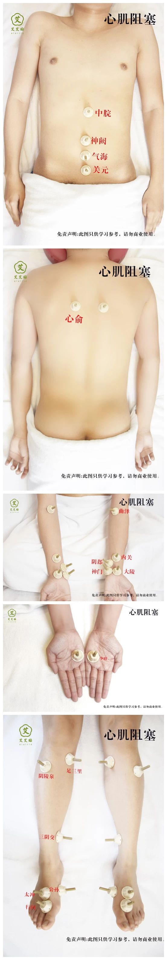 艾艾贴心肌阻塞穴位图片 艾艾贴心肌阻塞穴位图片