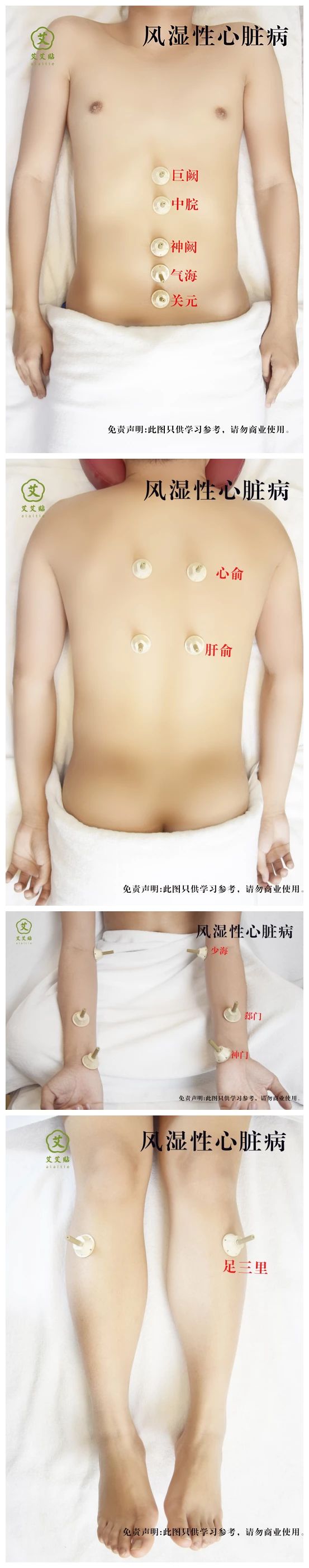 艾艾贴艾灸风湿性心脏病 艾艾贴艾灸风湿性心脏病