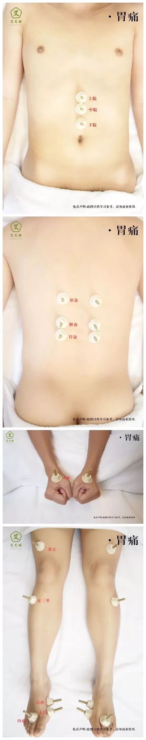艾艾贴调理胃痛的艾灸图片