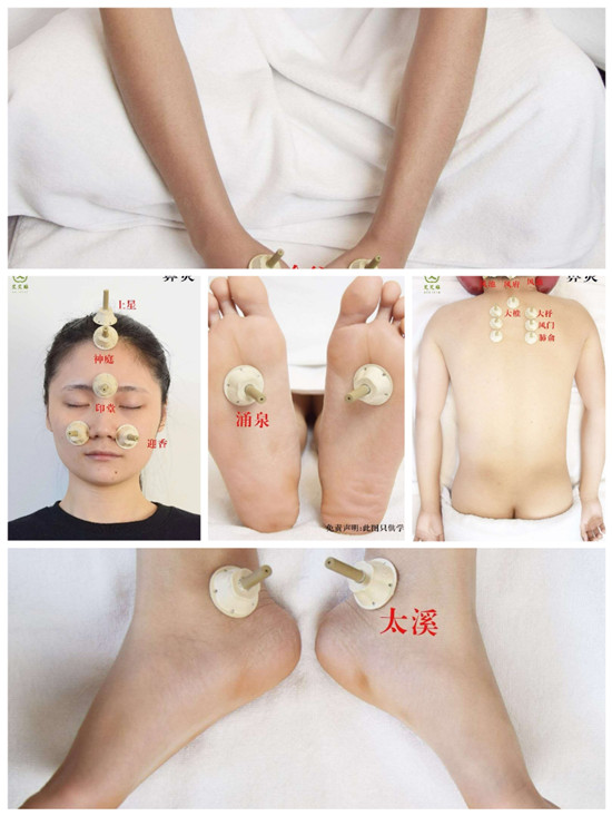艾艾贴艾灸调理:鼻炎