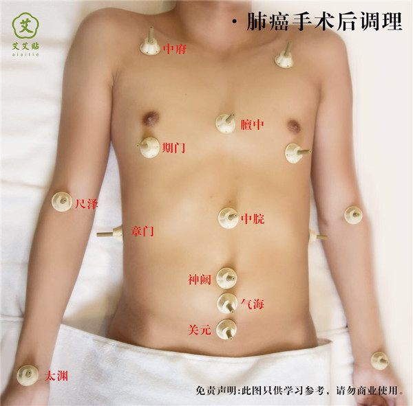 肺癌艾灸哪里？怎么贴？艾艾贴使用方法 穴位图