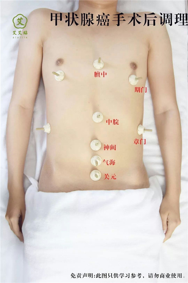 甲状腺癌手术后调理艾灸哪里？怎么贴？艾艾贴