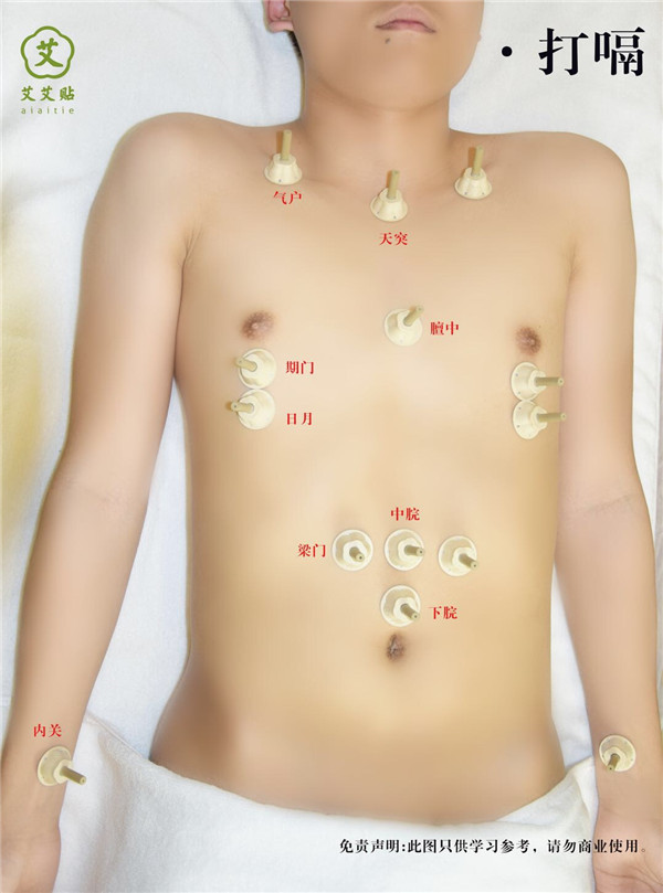 打嗝艾灸哪里？怎么贴？艾艾贴使用方法 穴位图