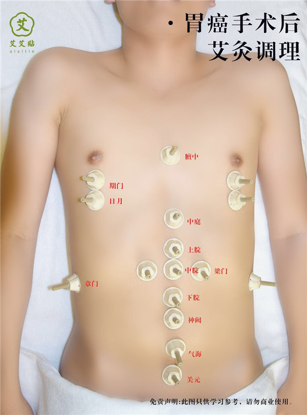 胃癌手术后艾灸调理艾灸哪里？怎么贴？艾艾贴