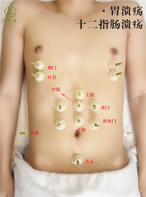 胃溃疡艾灸哪里？怎么贴？艾艾贴使用方法