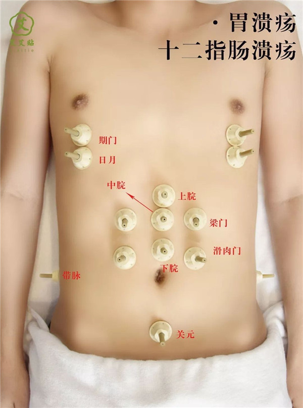 消化性溃疡艾灸哪里？怎么贴？艾艾贴使用方法