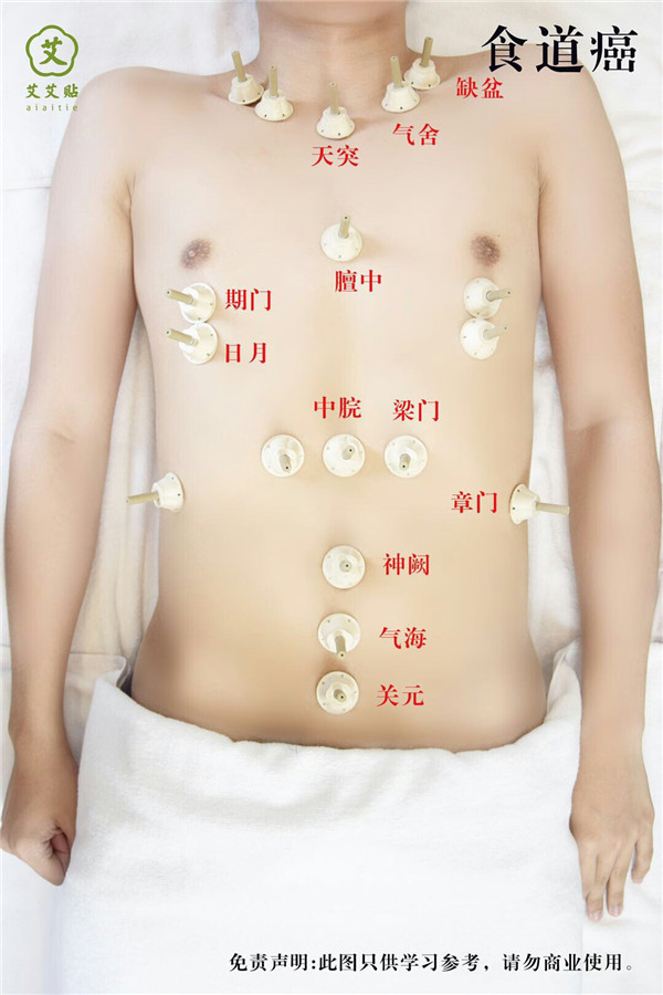 食道癌艾灸哪里？怎么贴？艾艾贴使用方法