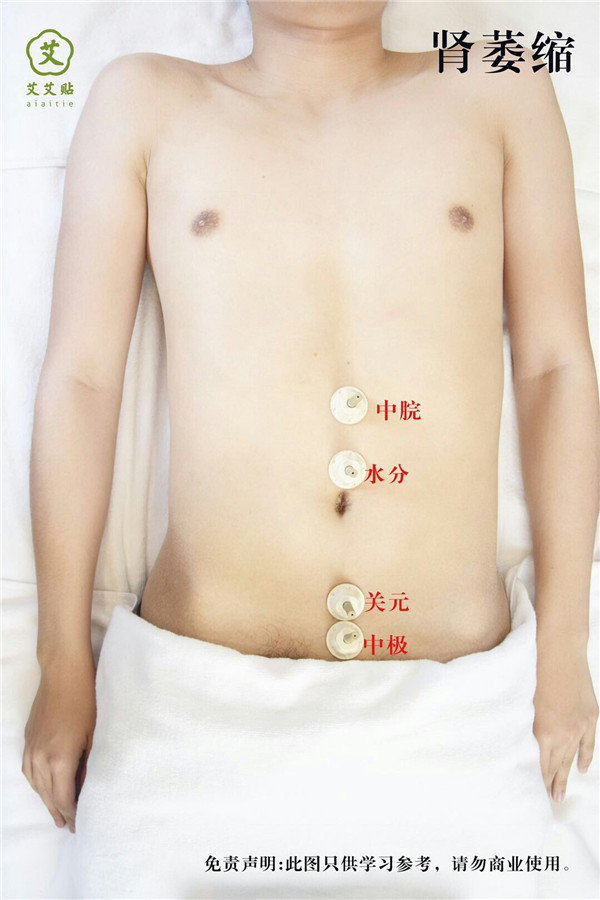 肾萎缩艾灸哪里？怎么贴？艾艾贴使用方法