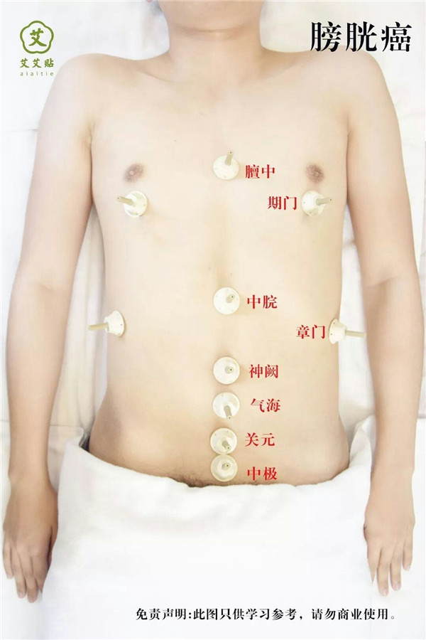 膀胱癌艾灸哪里？怎么贴？艾艾贴使用方法