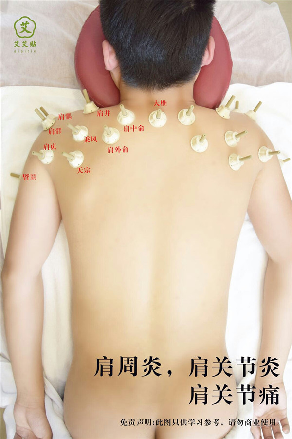 肩周炎艾灸哪里？怎么贴？艾艾贴使用方法